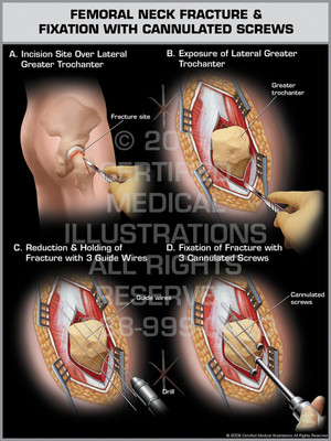 Exhibit of Femoral Neck Fracture & Fixation with Cannulated Screws. Exhibit of Femoral Neck Fracture & Fixation with Cannulated Screws.