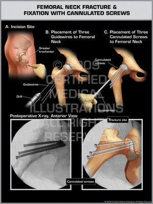 Exhibit of Femoral Neck Fracture & Fixation with Cannulated Screws 1. Exhibit of Femoral Neck Fracture & Fixation with Cannulated Screws 1.