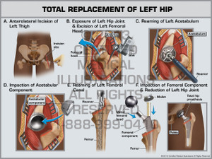 Exhibit of Total Replacement of Left Hip. Exhibit of Total Replacement of Left Hip.