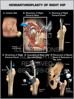 Exhibit of Hemiarthroplasty of Right Hip.