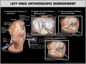 Exhibit of Left Knee Arthroscopic Debridement. Exhibit of Left Knee Arthroscopic Debridement.