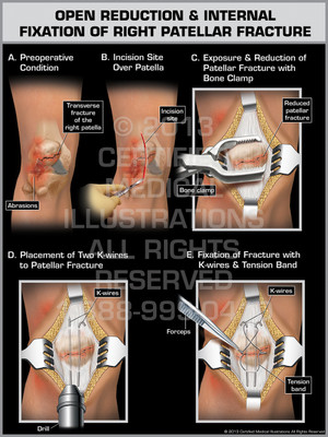Exhibit of Open Reduction & Internal Fixation of Right Patellar Fracture. Exhibit of Open Reduction & Internal Fixation of Right Patellar Fracture.