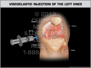 Exhibit of Viscoelastic Injection of the Left Knee.