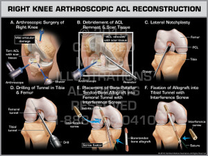 Exhibit of Right Knee Arthroscopic ACL Reconstruction. Exhibit of Right Knee Arthroscopic ACL Reconstruction.