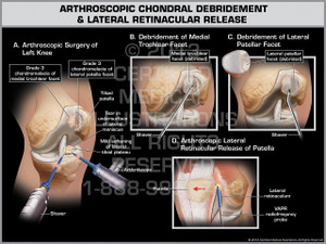 Exhibit of Arthroscopic Chondral Debridement & Lateral Retinacular Release. Exhibit of Arthroscopic Chondral Debridement & Lateral Retinacular Release.