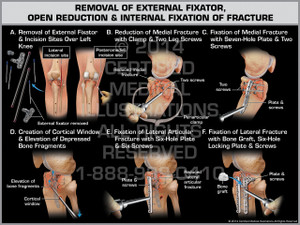 Exhibit of Removal of External Fixator, Open Reduction & Internal Fixation of Fracture.