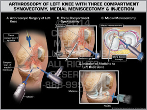 Arthroscopy of Left Knee with Three Compartment Synovectomy, Medial Meniscectomy & Injection