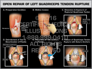 Open Repair of Left Quadriceps Tendon Rupture Open Repair of Left Quadriceps Tendon Rupture