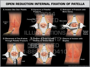 Open Reduction Internal Fixation of Patella