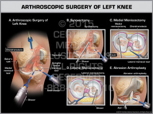 Arthroscopic Surgery of Left Knee Arthroscopic Surgery of Left Knee