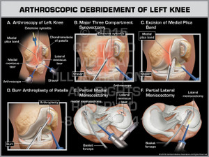 Arthroscopic Debridement of Left Knee Arthroscopic Debridement of Left Knee