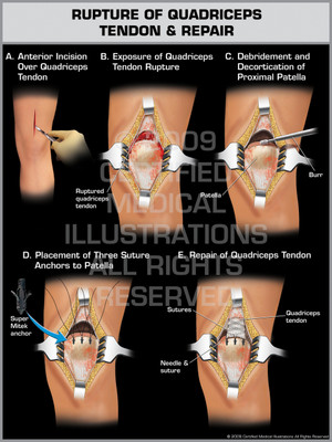 Exhibit of Rupture of Quadriceps Tendon & Repair.