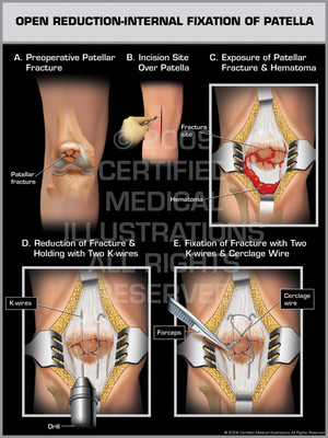 Open Reduction-Internal Fixation of Patella Open Reduction-Internal Fixation of Patella