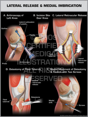 Lateral Release & Medial Imbrication Lateral Release & Medial Imbrication
