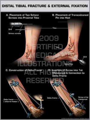 Exhibit of Distal Tibial Fracture & External Fixation.
