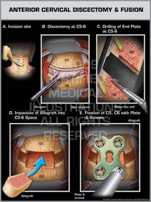 Exhibit of Anterior Cervical Discectomy & Fusion Female.