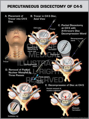 Exhibit of Percutaneous Discectomy of C4-5 1. Exhibit of Percutaneous Discectomy of C4-5 1.