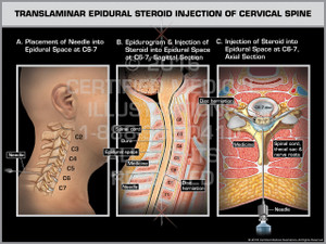 Exhibit of Translaminar Epidural Steroid Injection of Cervical Spine Male.