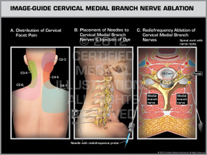 Exhibit of Image-Guide Cervical Medial Branch Nerve Ablation Female. Exhibit of Image-Guide Cervical Medial Branch Nerve Ablation Female.