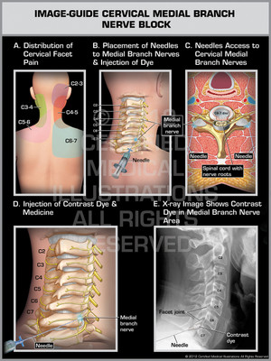 Exhibit of Image-Guide Cervical Medial Branch Nerve Block Female. Exhibit of Image-Guide Cervical Medial Branch Nerve Block Female.