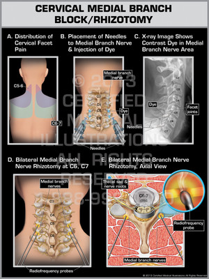 Exhibit of Cervical Medial Branch Block/Rhizotomy. Exhibit of Cervical Medial Branch Block/Rhizotomy.