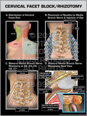 Exhibit of Cervical Facet Block/Rhizotomy.