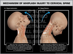 Exhibit of Mechanism of Whiplash Injury to Cervical Spine Female. Exhibit of Mechanism of Whiplash Injury to Cervical Spine Female.