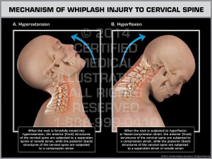 Exhibit of Mechanism of Whiplash Injury to Cervical Spine Male. Exhibit of Mechanism of Whiplash Injury to Cervical Spine Male.