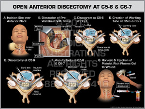 Exhibit of Open Anterior Discectomy at C5-6 & C6-7.