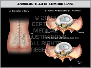Exhibit of Annular Tear of Lumbar Spine.