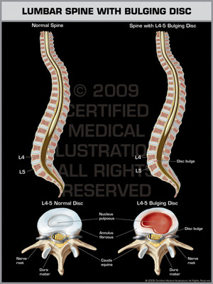 Exhibit of Lumbar Spine with Bulging Disc. Exhibit of Lumbar Spine with Bulging Disc.
