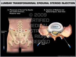 Exhibit of Lumbar Transforaminal Epidural Steroid Injection. Exhibit of Lumbar Transforaminal Epidural Steroid Injection.