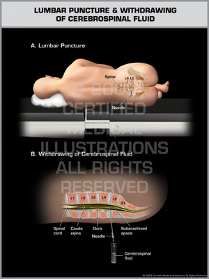 Exhibit of Lumbar Puncture & Withdrawing of Cerebrospinal Fluid. Exhibit of Lumbar Puncture & Withdrawing of Cerebrospinal Fluid.
