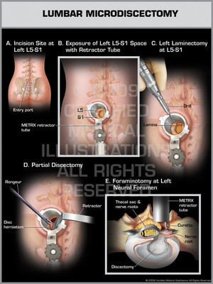 Exhibit of Lumbar Microdiscectomy.