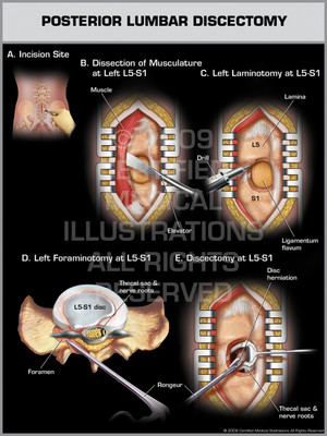 Exhibit of Posterior Lumbar Discectomy. Exhibit of Posterior Lumbar Discectomy.