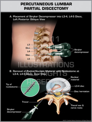 Exhibit of Percutaneous Lumbar Partial Discectomy.