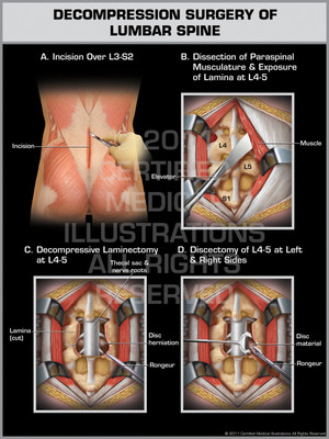 Exhibit of Decompression Surgery of Lumbar Spine.