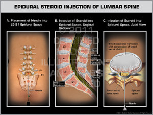 Exhibit of Epidural Steroid Injection of Lumbar Spine.