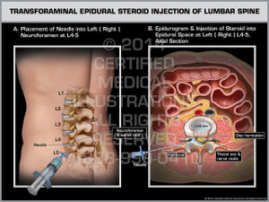 Exhibit of Epidural Steroid Injection of Lumbar Spine. Exhibit of Epidural Steroid Injection of Lumbar Spine.