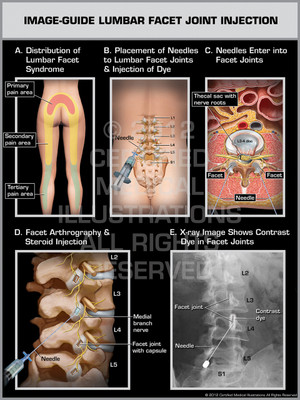 Exhibit of Image-Guide Lumbar Facet Joint Injection Female.