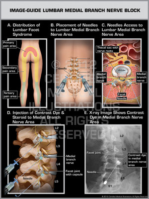 Exhibit of Image-Guide Lumbar Medial Branch Nerve Block Female.