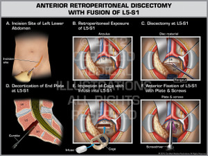 Exhibit of Anterior Retroperitoneal Discectomy with Fusion of L5-S1. Exhibit of Anterior Retroperitoneal Discectomy with Fusion of L5-S1.
