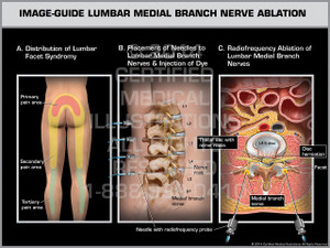 Exhibit of Image-Guide Lumbar Medial Branch Nerve Ablation Male. Exhibit of Image-Guide Lumbar Medial Branch Nerve Ablation Male.