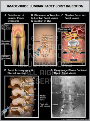 Exhibit of Image-Guide Lumbar Facet Joint Injection Male.