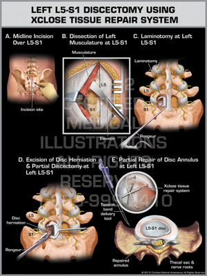Exhibit of Left L5-S1 Discectomy Using XClose Tissue Repair System. Exhibit of Left L5-S1 Discectomy Using XClose Tissue Repair System.
