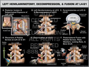 Exhibit of Left Hemilaminotomy, Decompression, & Fusion at L4-S1. Exhibit of Left Hemilaminotomy, Decompression, & Fusion at L4-S1.