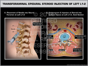 Exhibit of Transforaminal Epidural Steroid Injection of Left L1-2. Exhibit of Transforaminal Epidural Steroid Injection of Left L1-2.