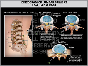Exhibit of Discogram of Lumbar Spine at L3-4, L4-5 & L5-S1. Exhibit of Discogram of Lumbar Spine at L3-4, L4-5 & L5-S1.