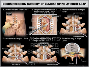 Exhibit of Decompression Surgery of Lumbar Spine at Right L5-S1. Exhibit of Decompression Surgery of Lumbar Spine at Right L5-S1.