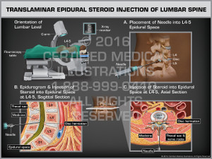 Exhibit of Translaminar Epidural Steroid Injection of Lumbar Spine. Exhibit of Translaminar Epidural Steroid Injection of Lumbar Spine.